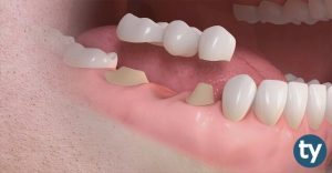 Diş Protez Teknisyeni KPSS 2020/14 Atama Taban Puanları
