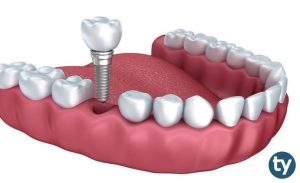 Diş Protez Teknolojisi KPSS 2019/1 Atama Taban Puanları