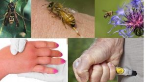Arı allerjisi hakkında her şey!!