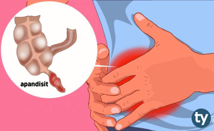 kolonoskopi nedir ve nasil yapilir h6871 d3857